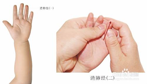 小儿咳嗽——小儿推拿妙处