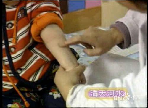 小儿鼻出血中医推拿手法