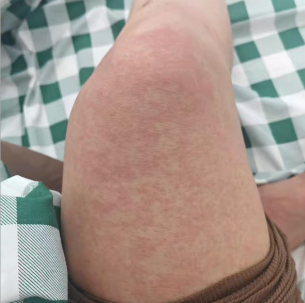 佛山累计报告基孔肯雅热超3600例，患者口述：最难受的是......