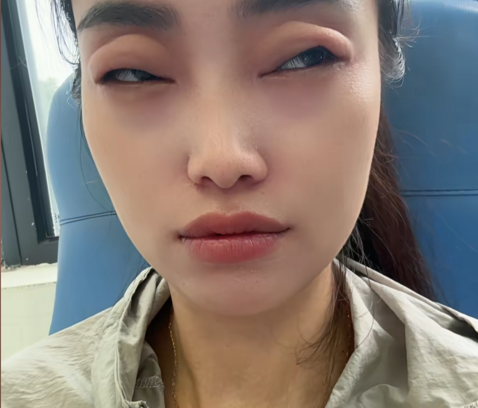 杨梅大量上市，有人吃完秒变“悲伤蛙”，严重的或有生命危险，医生提醒