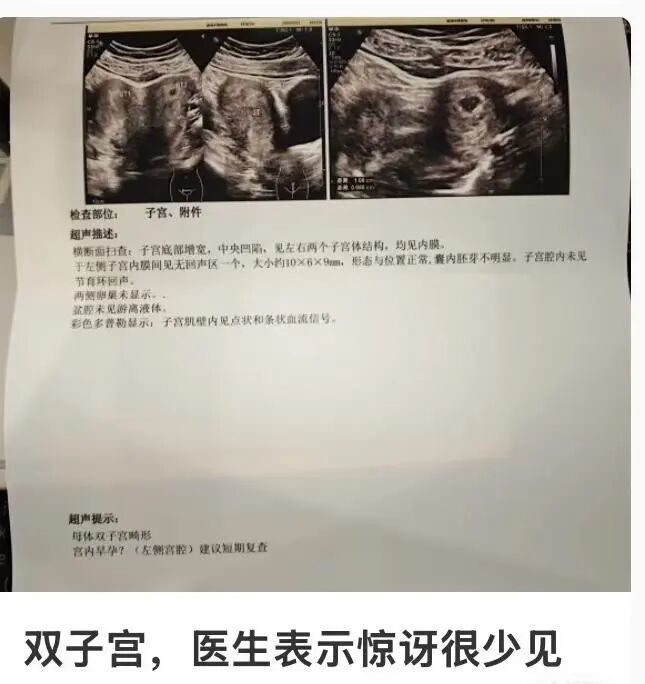“本次怀孕在左侧!”双子宫孕妈发文引发热议!医生:少见但不罕见,多数不需干预