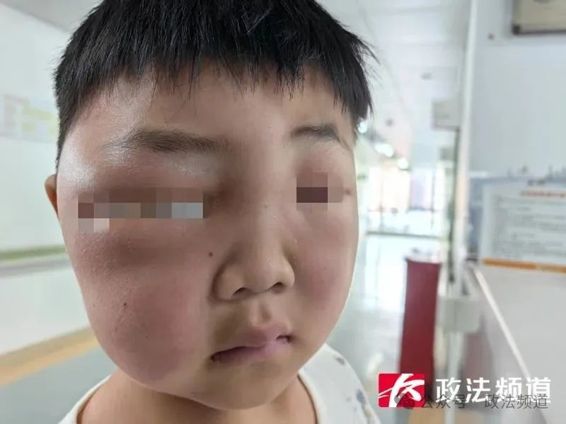 孩子一觉醒来全脸肿胀，爹妈傻眼了！长沙一家医院近期收治多例，医生提醒