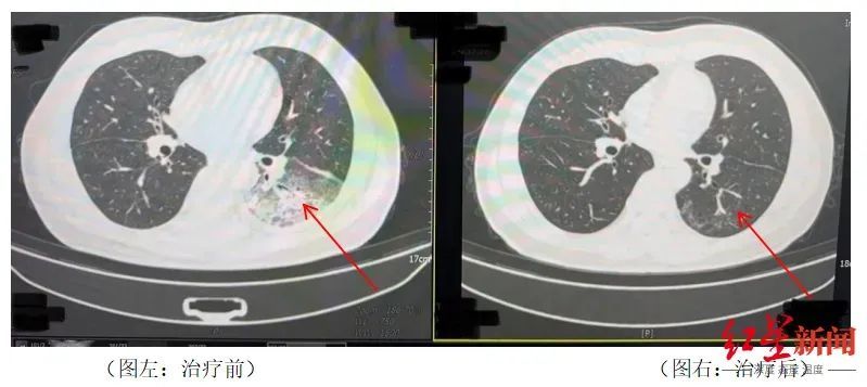 吹空调感染肺炎致“白肺”！专家重要提醒