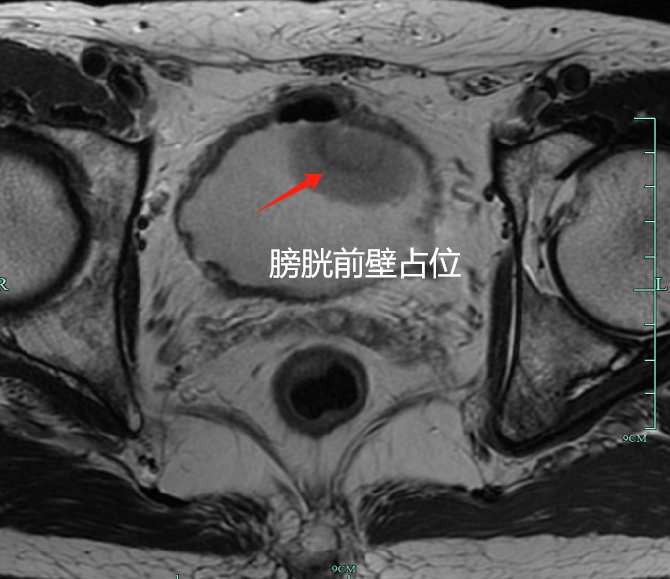 不痛不痒,要切除重要器官?男子悔惨:这里长肿块90%是恶性癌!