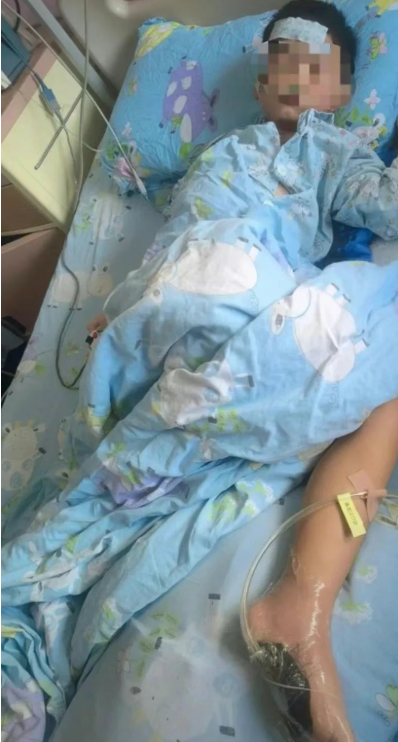 6岁男童沙滩光脚踩到死鱼，次日高烧进ICU！医生紧急提醒