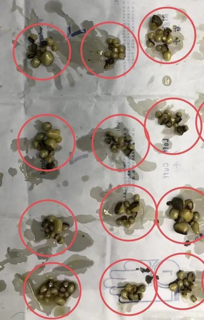 密密麻麻！湖北女子体内查出上千颗结石！医生提醒