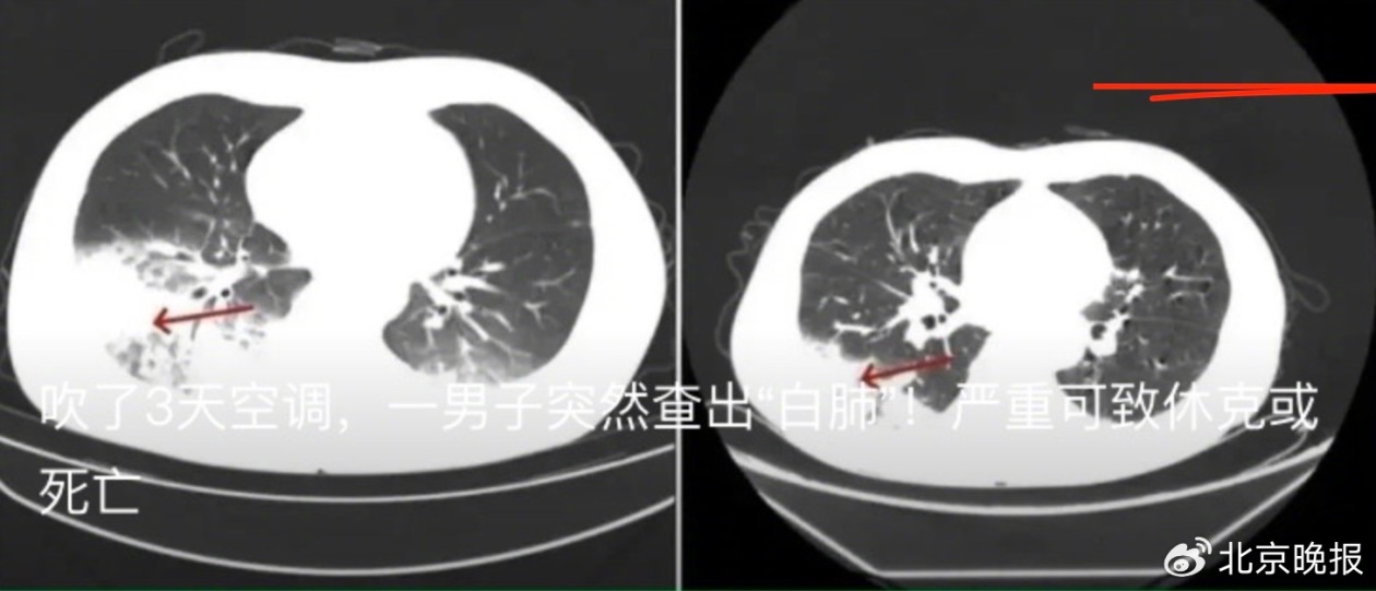 空调吹成白肺？这个致病菌到底从何而来