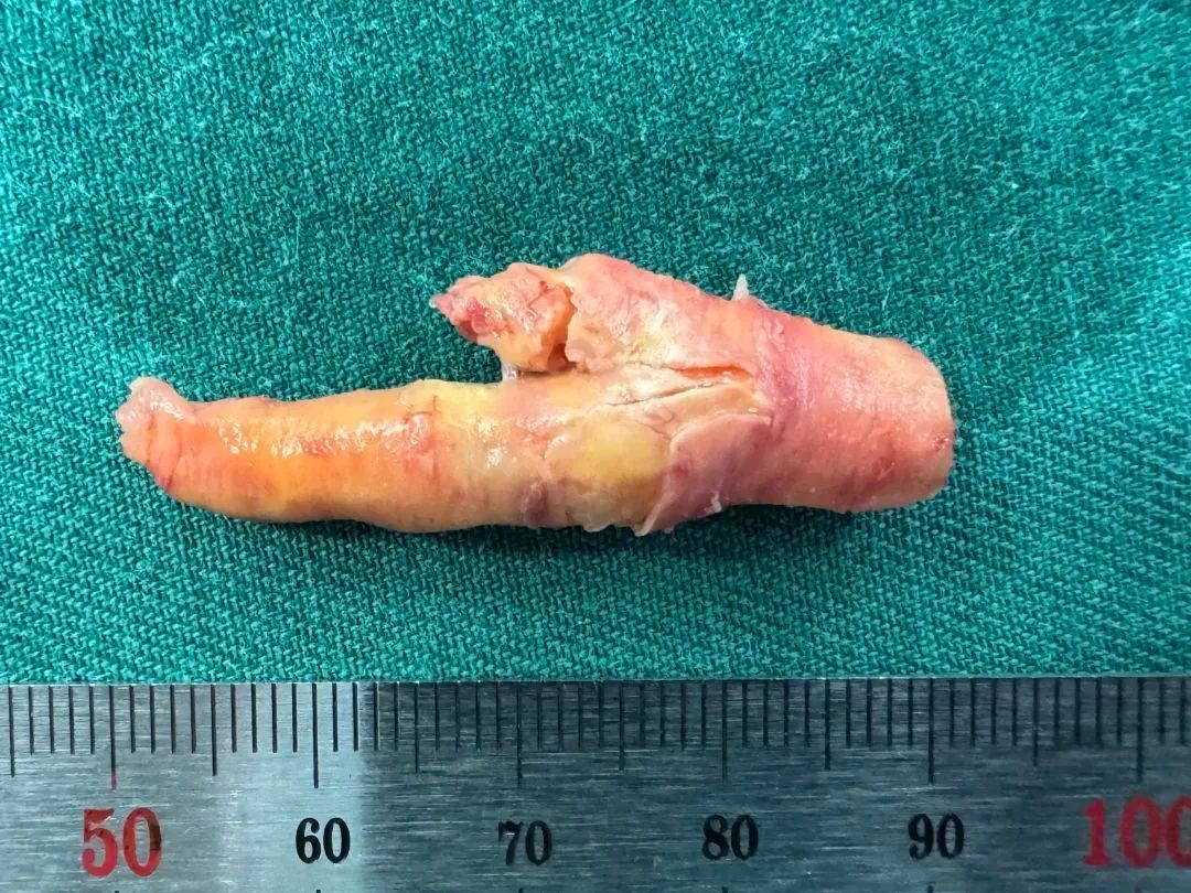 惊呆！男子血管里掏出一只“鸡爪”！这个习惯很多人都有……年龄到了请务必重视