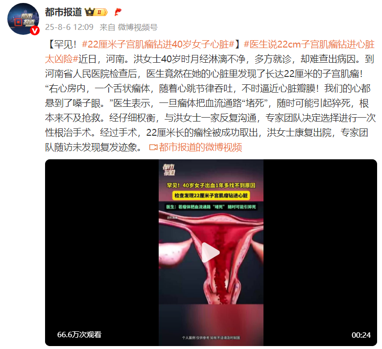 罕见！22厘米子宫肌瘤钻进40岁女子心脏