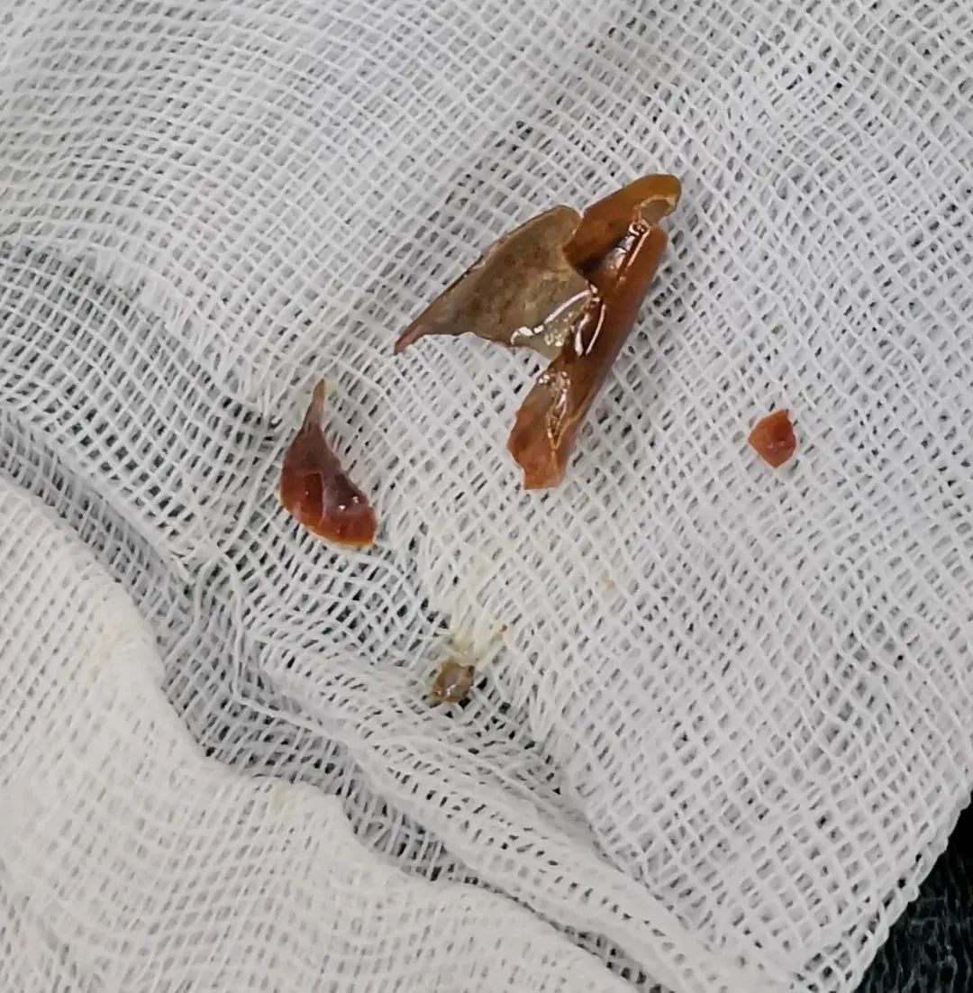 啥情况？男子夏天裹着厚棉服，高烧40℃！只因这一口辣椒……