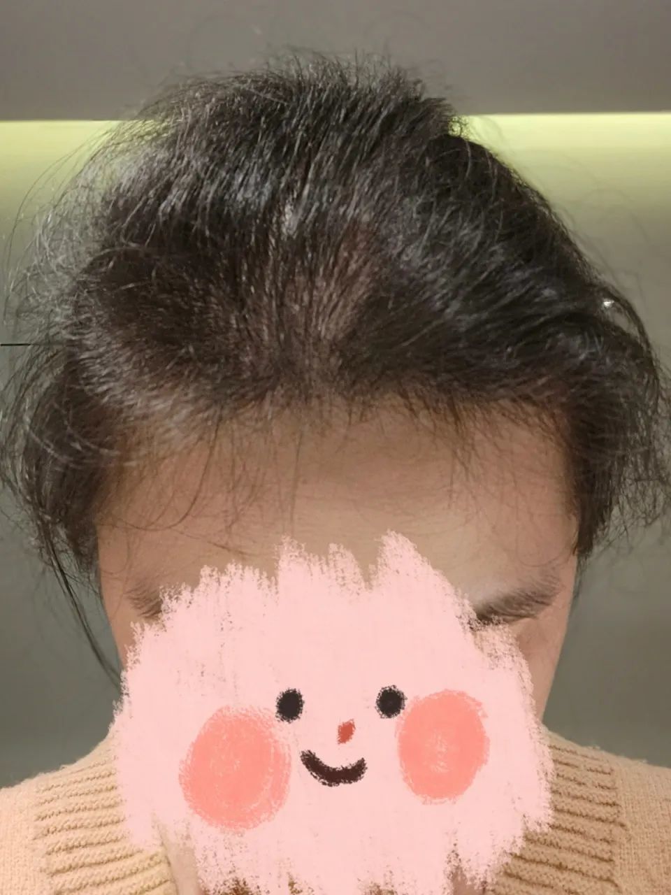 30岁被误认为奶奶，女子称脱发令人自卑：一胎后剃光头发，后悔没及时就医