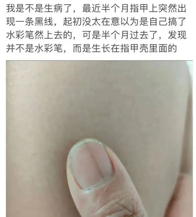 紧急提醒:指甲出现这个变化,可能是癌变!别不当回事