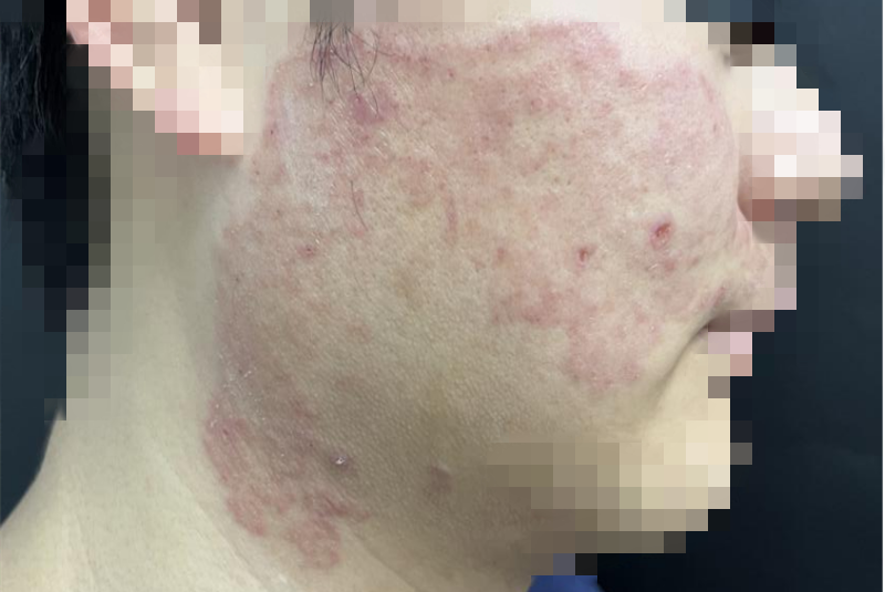 把擦脚巾当洗脸巾竟导致“脚气”上脸，宁波27岁帅小伙惨不忍睹！医生：一人感染，可传染全家！很多人没当回事