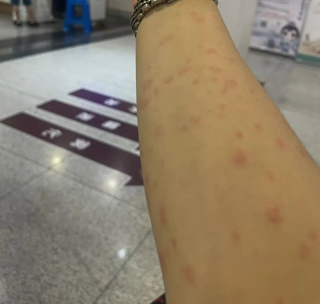 “密密麻麻!”富阳女子接连中招,很多人在用……医生:赶紧停掉