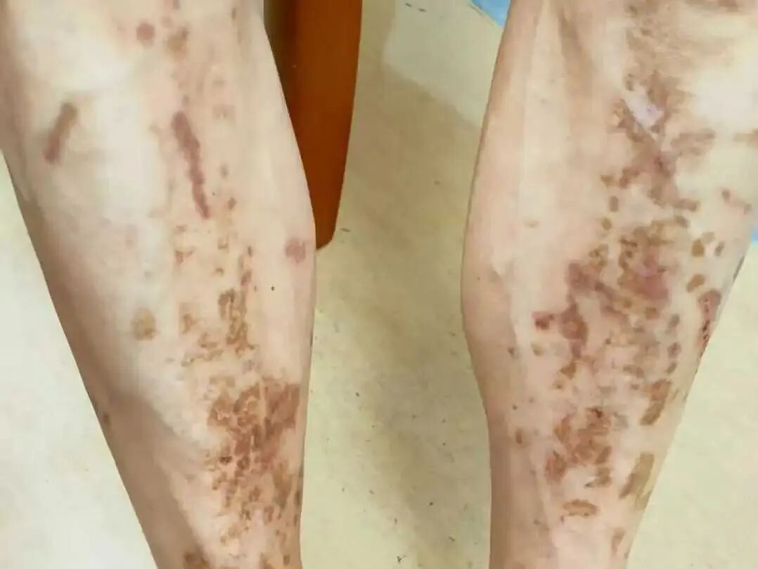 58岁大叔腿上突现不痛不痒褐红色斑片，医生：当心，这是皮肤替身体发出警告