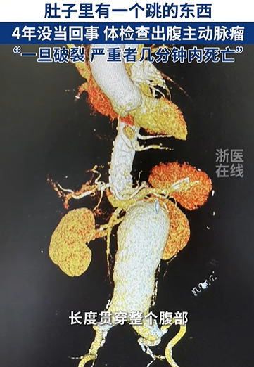 肚子里有个东西在跳！四年没当回事……体检后医生都震惊了，腹中竟有一个巨大腹主动脉瘤