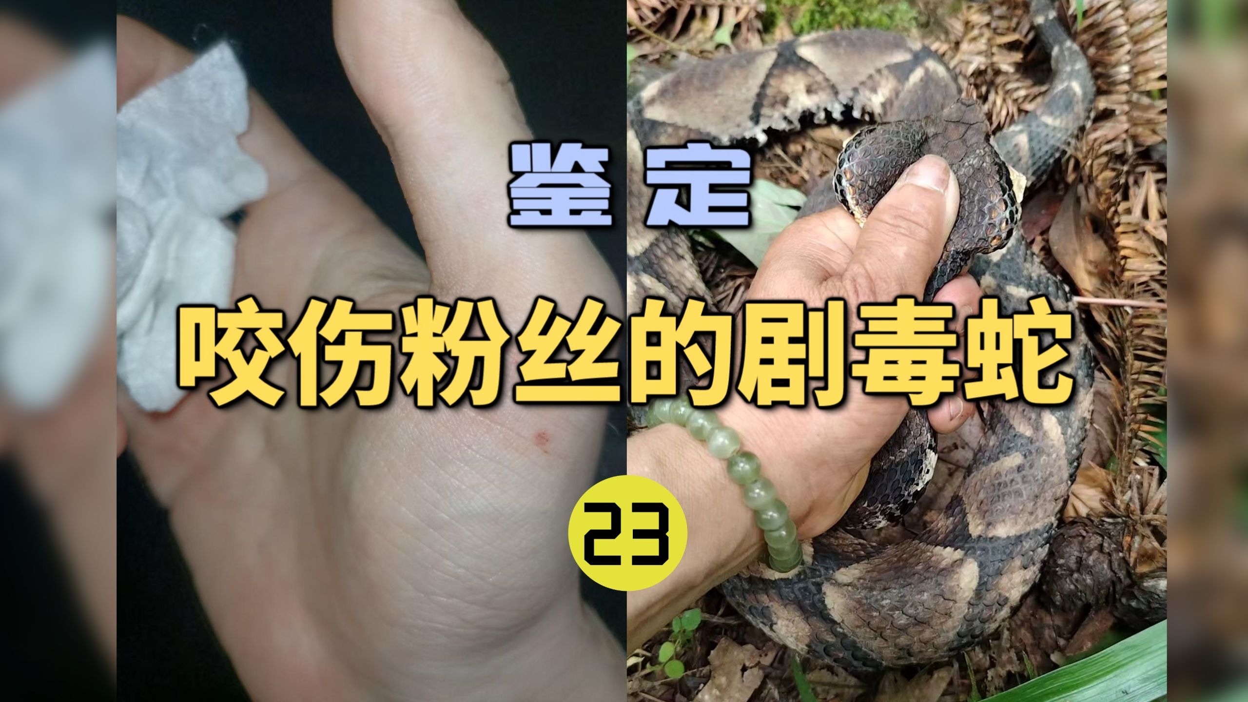 鉴定咬伤粉丝的毒蛇(23)被五步蛇咬伤竟然打了银环蛇血清？