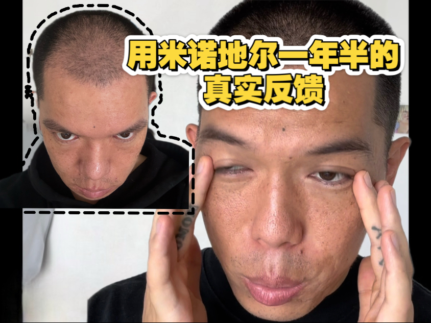 停用非那雄胺之后，我竟然……