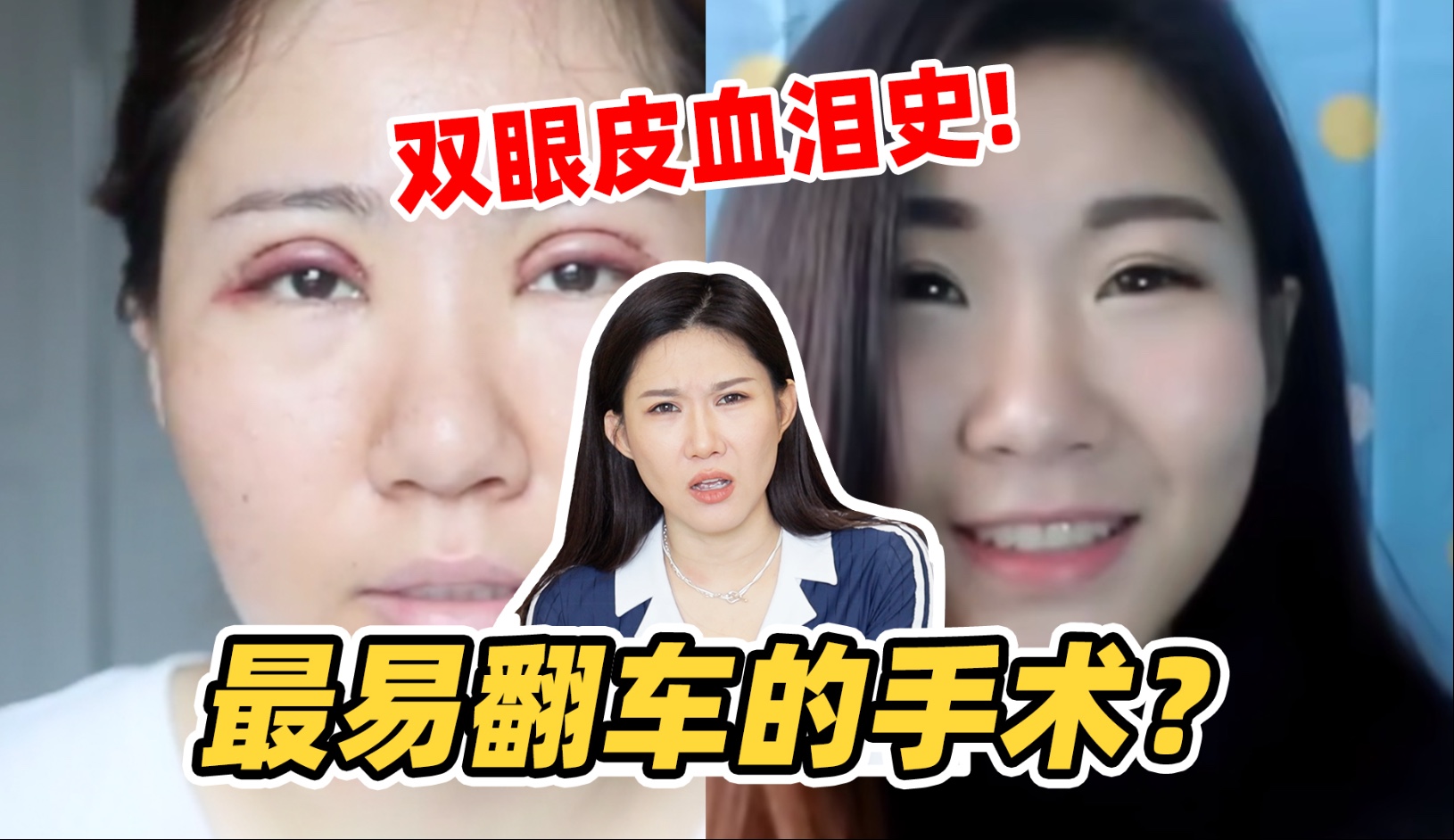 双眼皮修复后才敢说：这手术太容易翻车！我的失败+重生全记录