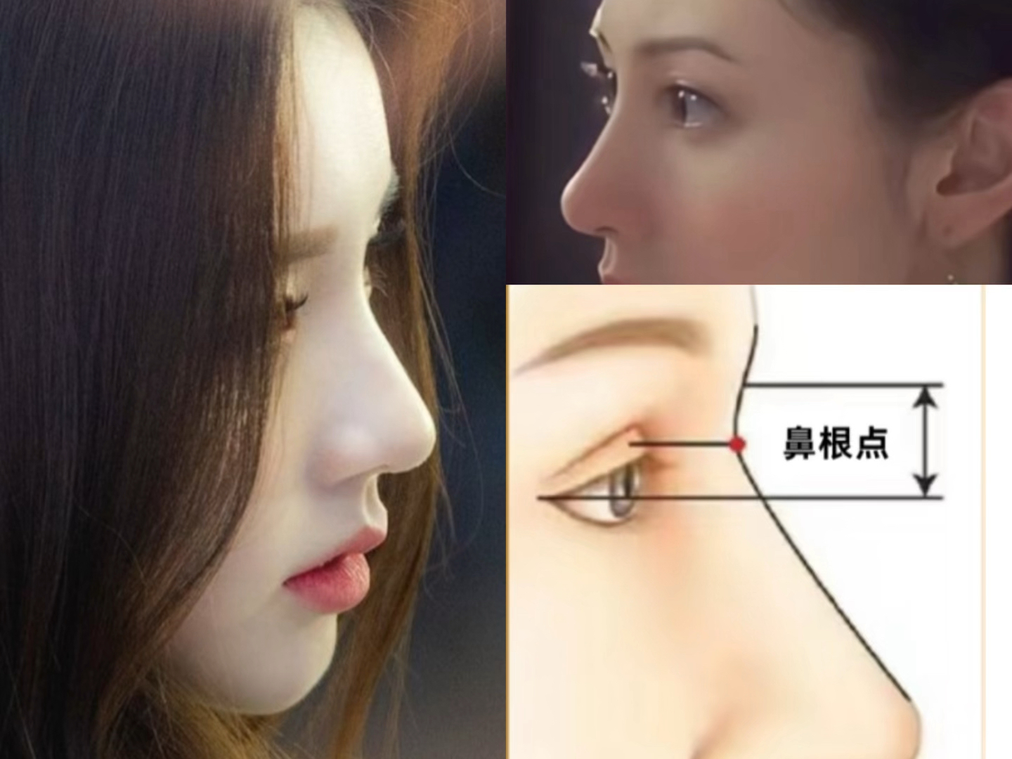 「自叠」理想的立体突出的高山根/挺拔美鼻/抬高鼻根完美衔接