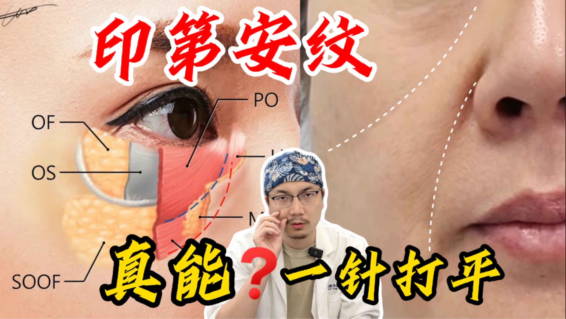 一针打平or反复治疗？这条纹到底怎么搞？