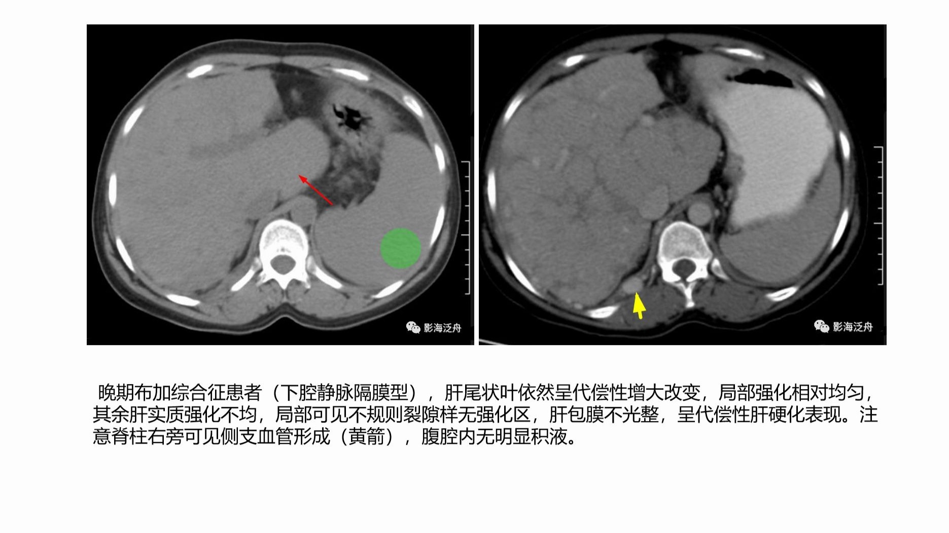 肝胆解剖与影像学基础（下）