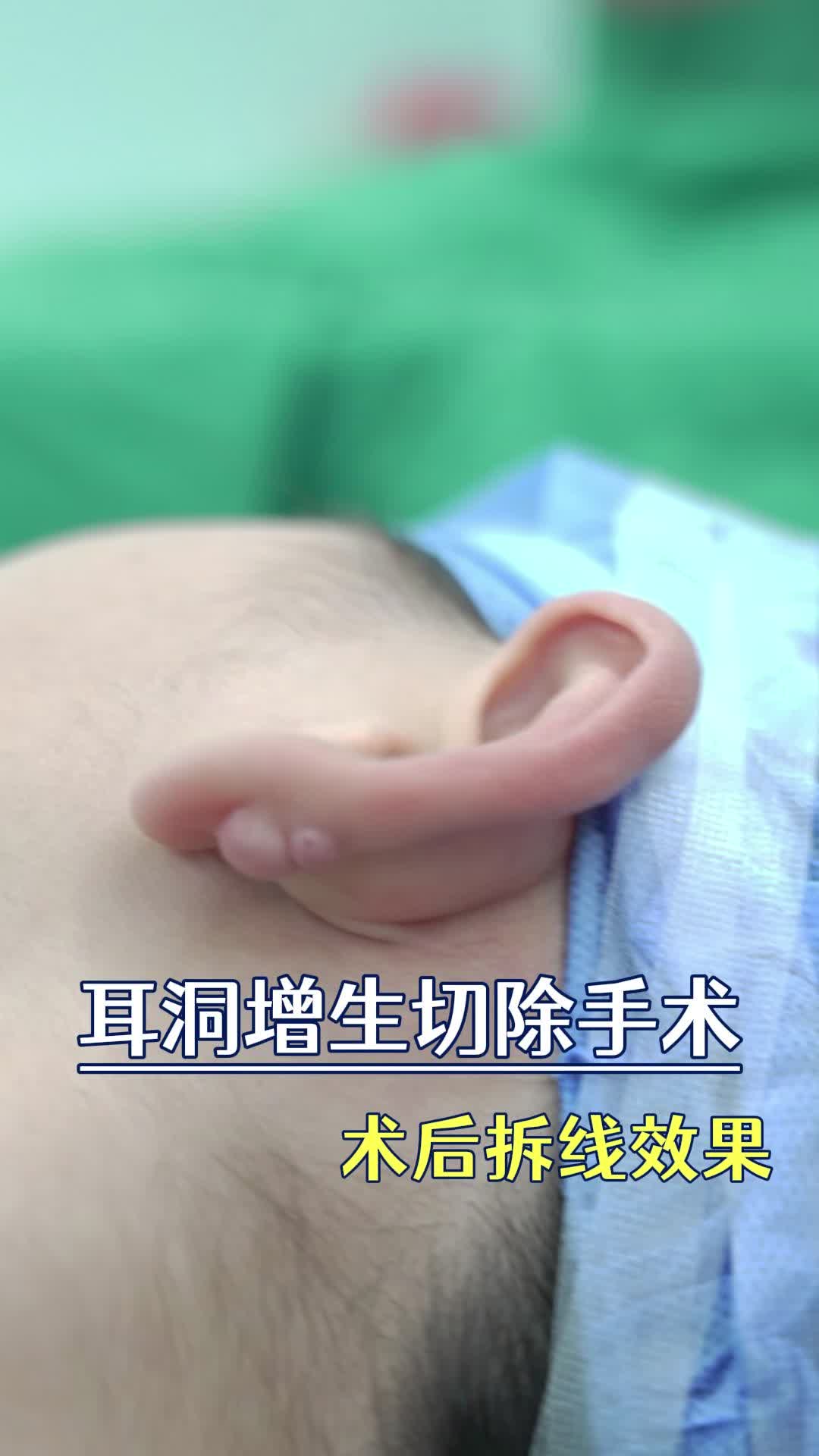 耳洞有增生？不用怕，切除修复很简单！