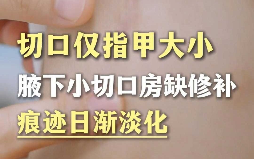 切口仅指甲大小！腋下小切口房缺修补，痕迹日渐淡化