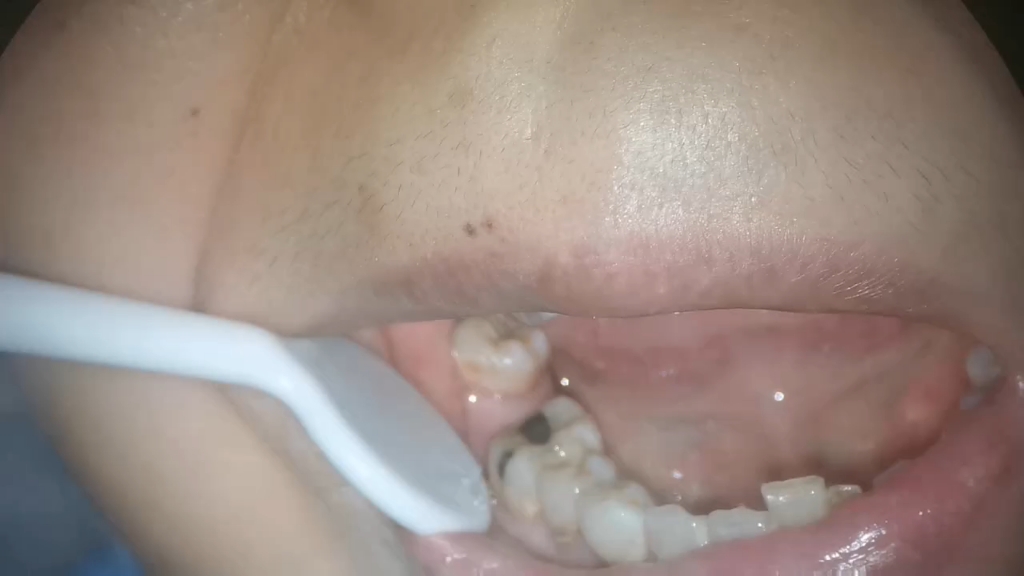 牙缝内的蛀牙已经开始疼了，一个根管，一颗补了！
