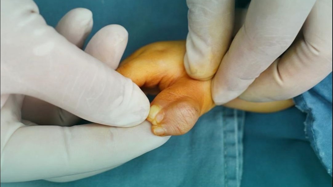 你知道术前宝宝有5个大拇指吗？妈妈：换药时我们就很满意