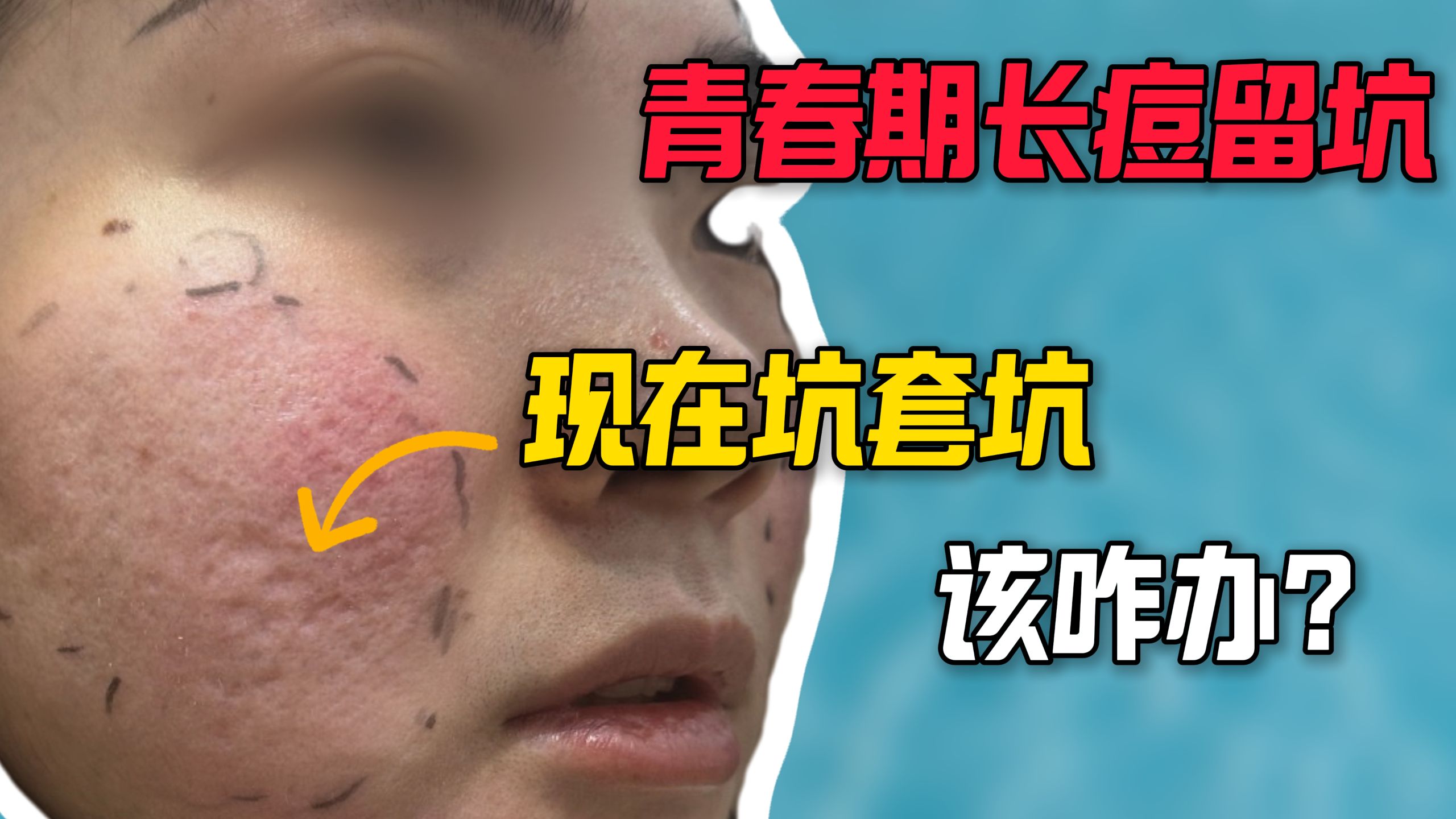 你有长过痘痘吗？坑友面颊坑套坑 影响社交和工作 该咋办？