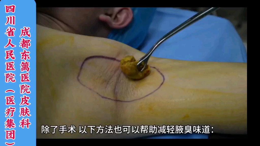 腋臭的几种治疗方法，四川省人民医院东篱医院