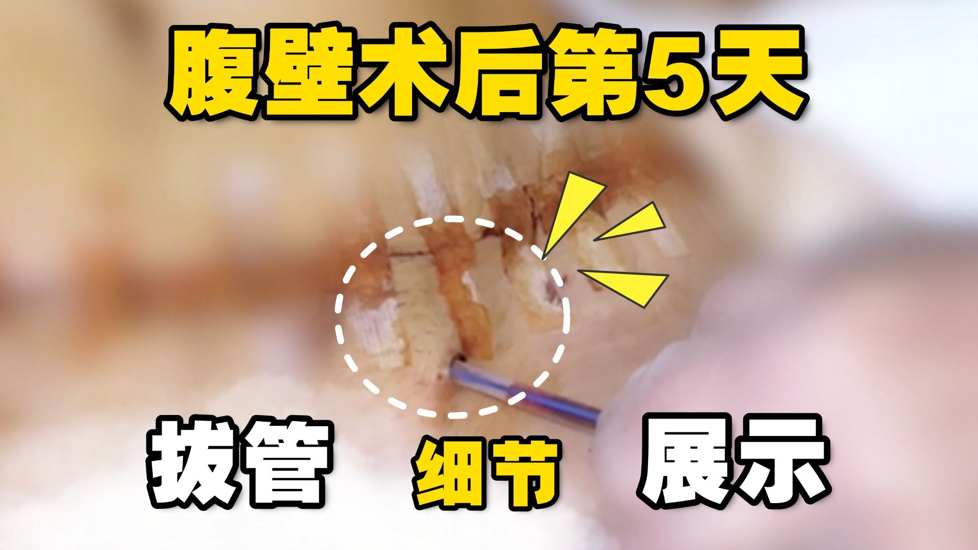 腹壁成形术后第5天拔管细节展示