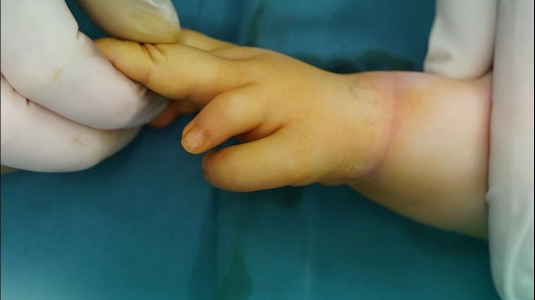 大拇指要美观还是要功能，On top技术把2个拼一下