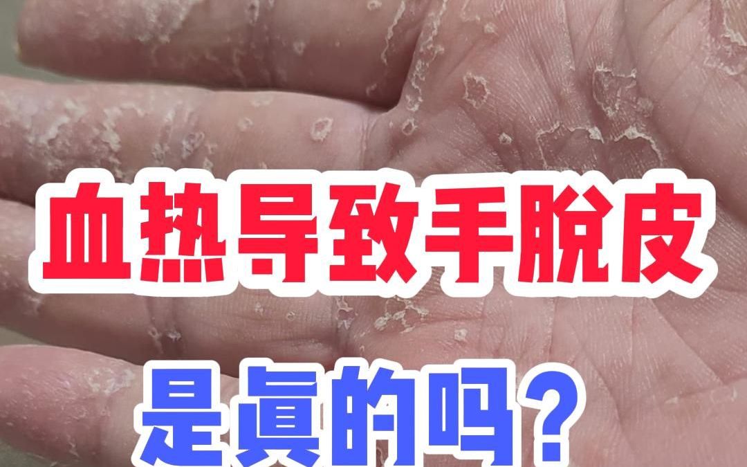 血热导致手脱皮是真的吗？