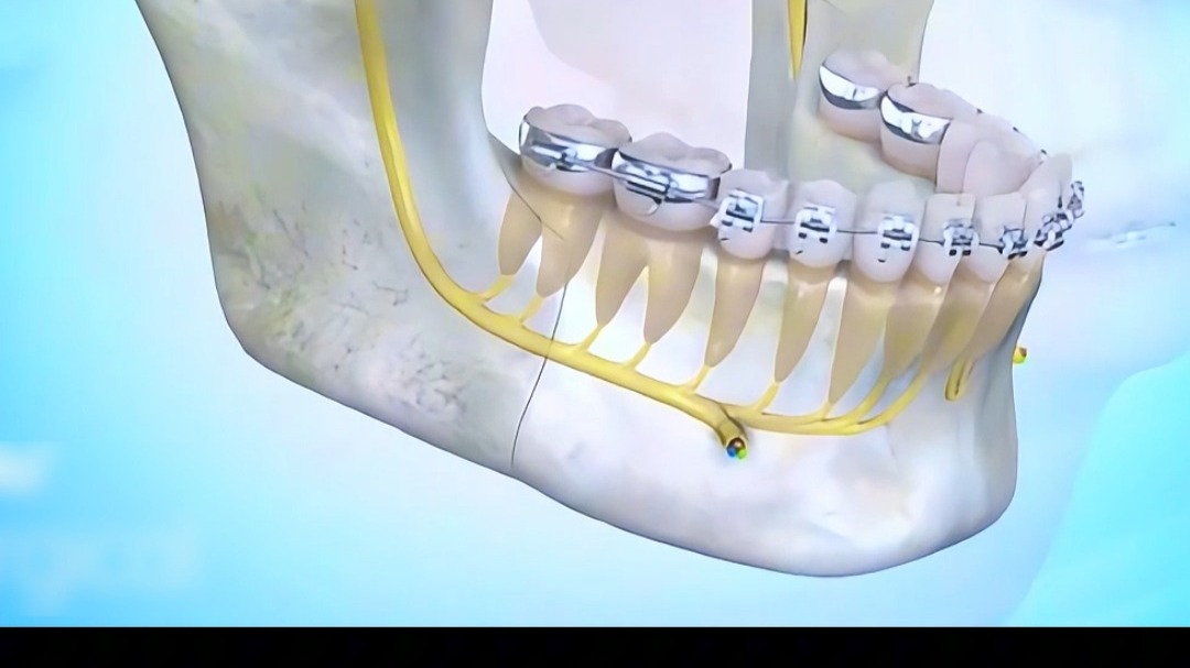 假如正颌手术并发症会说话