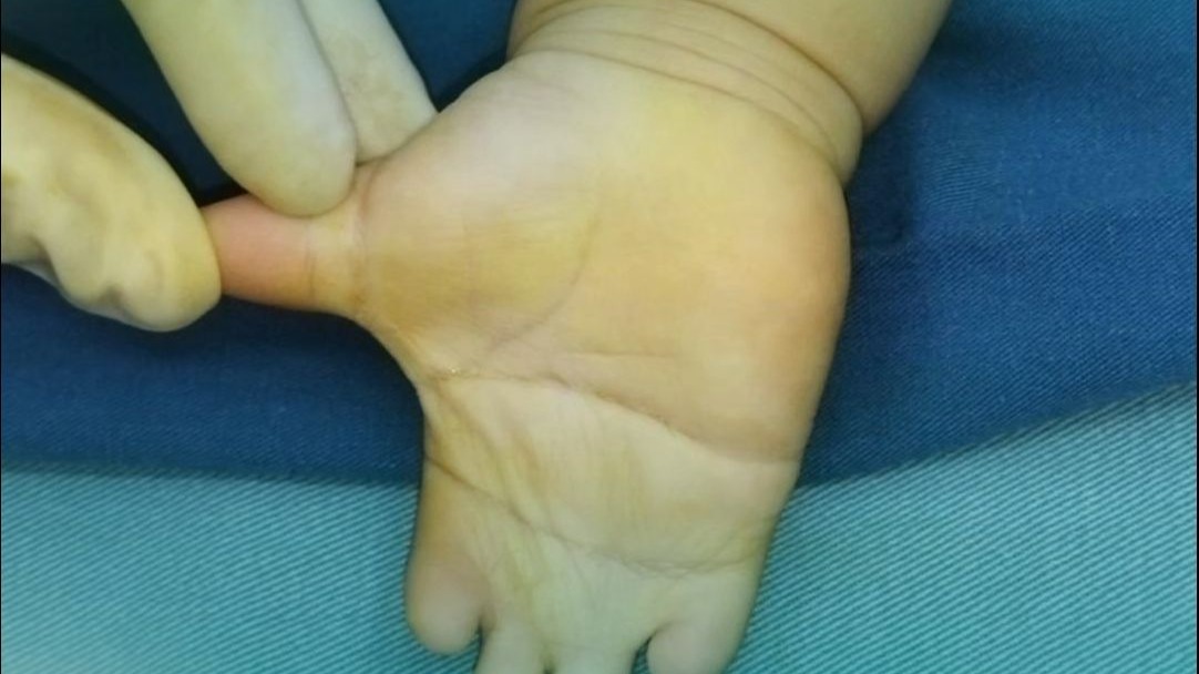 奶奶：天天愁的睡不着觉，别愁别愁，一次手术全分开