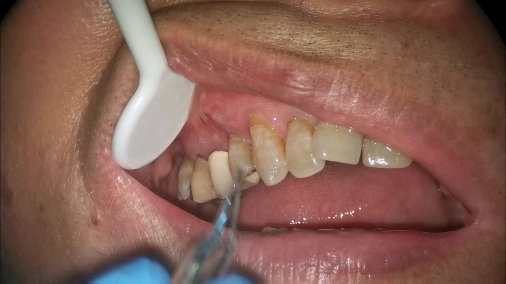 拔除因为牙根折断化脓的松动牙齿！