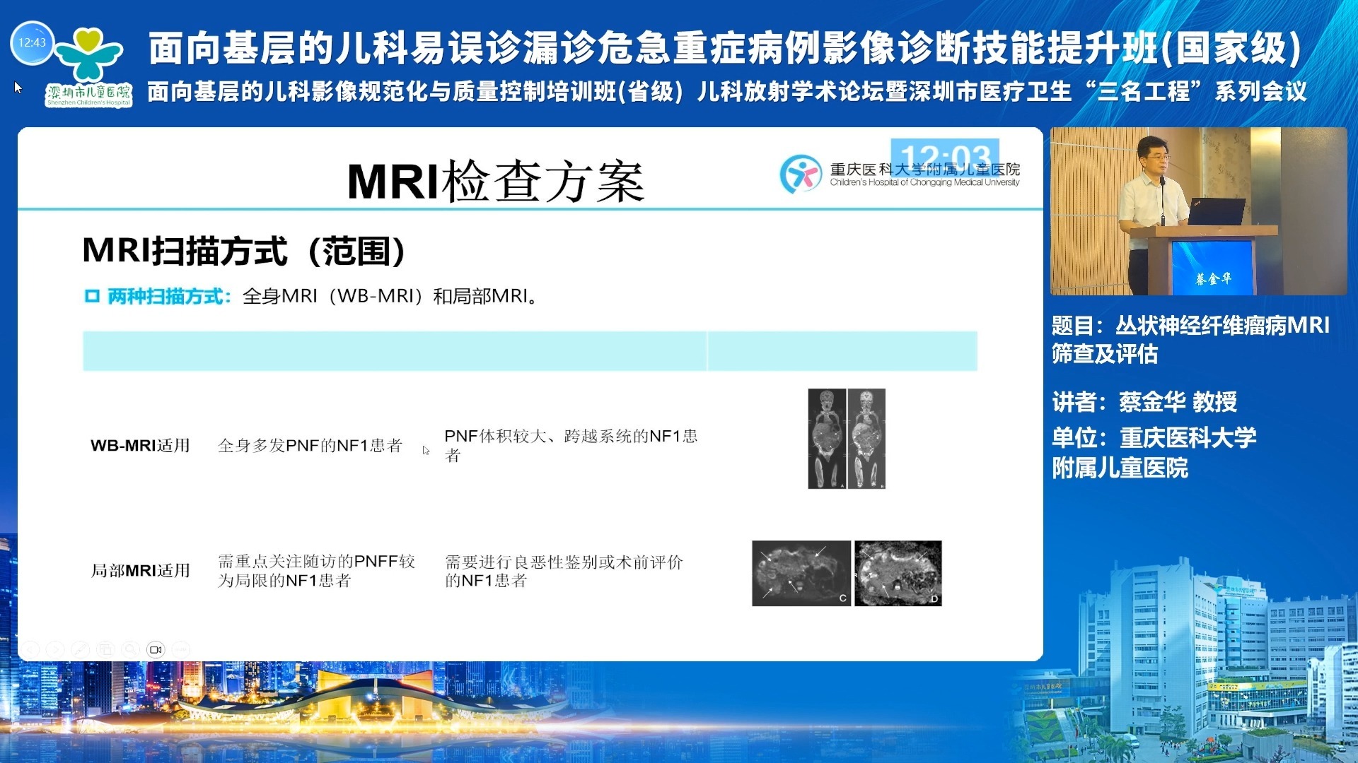 丛状神经纤维瘤MRI筛查及评估-蔡金华