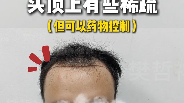 『1300单位」 三级脫发补前额