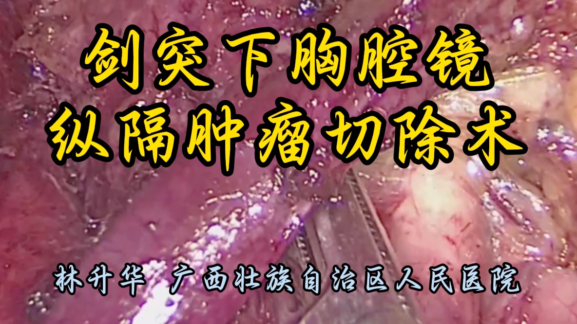 剑突下胸腔镜 纵隔肿瘤切除术 林升华教授供稿