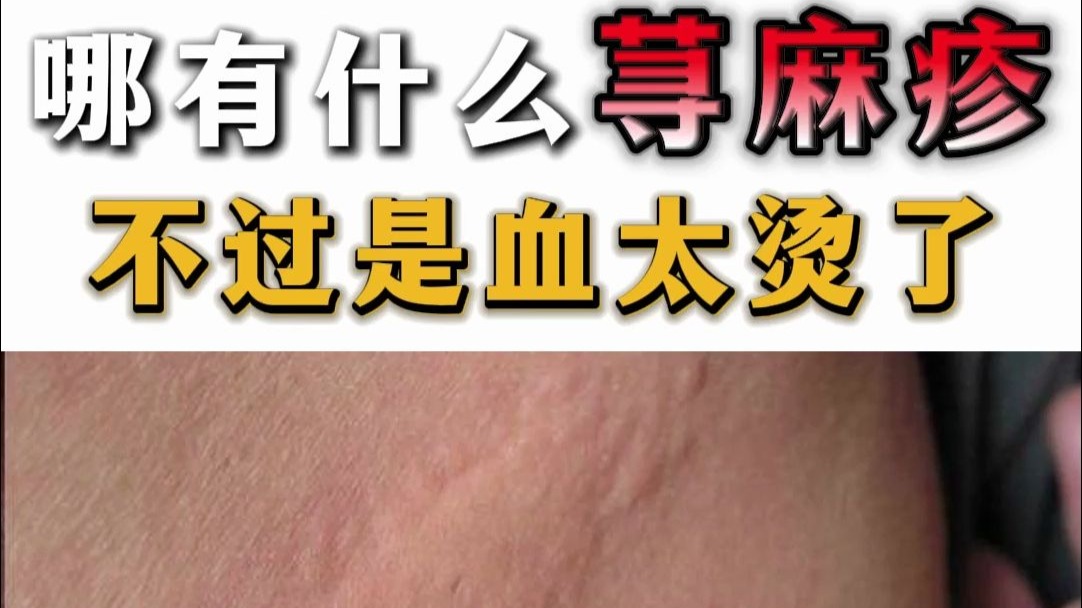 哪有什么荨麻疹 不过是血太烫了