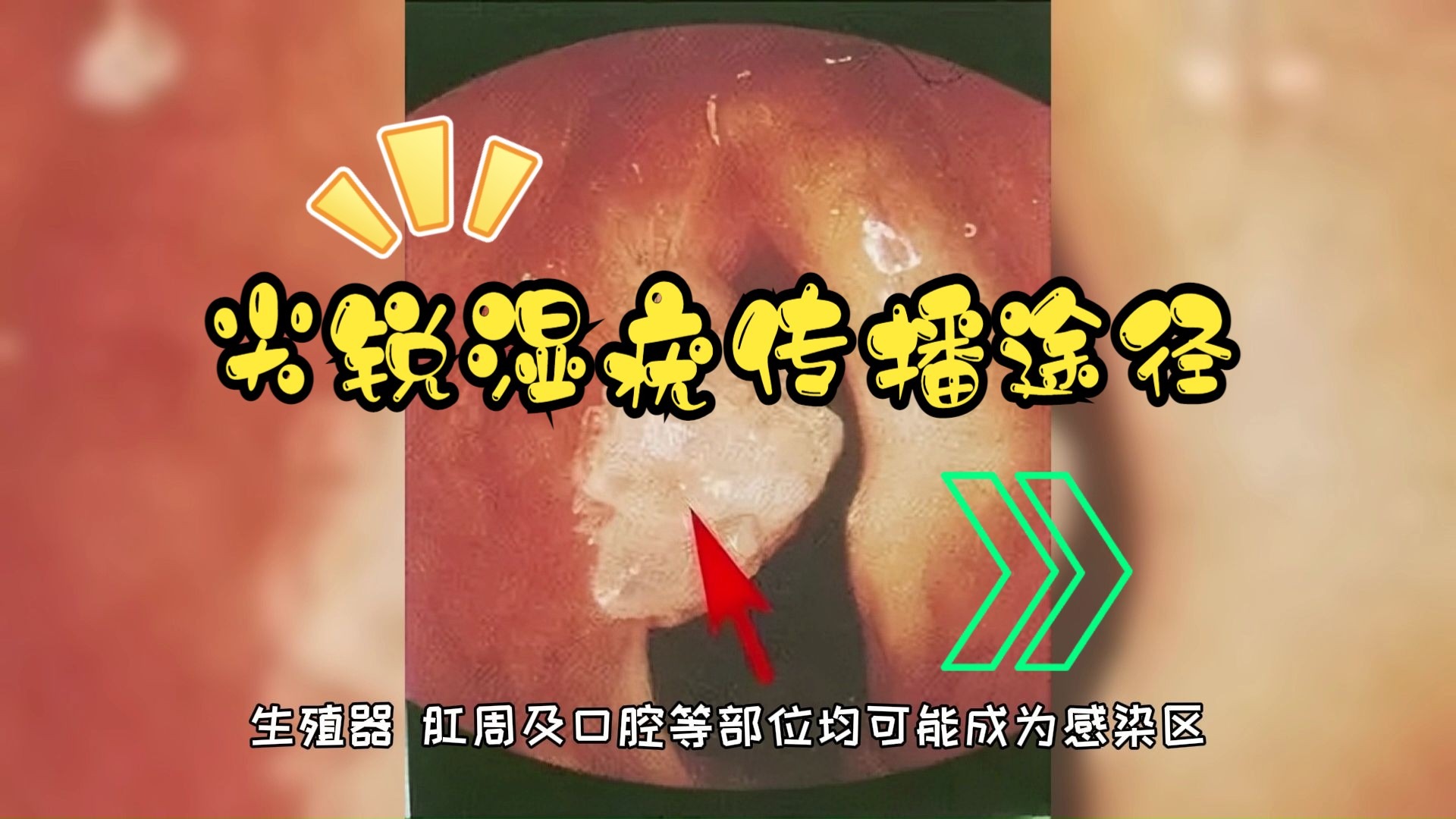 尖锐湿疣的传播途径有多少种