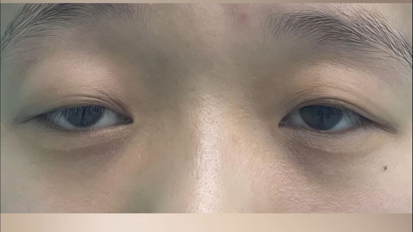 重度上睑下垂，为什么要做两次手术？