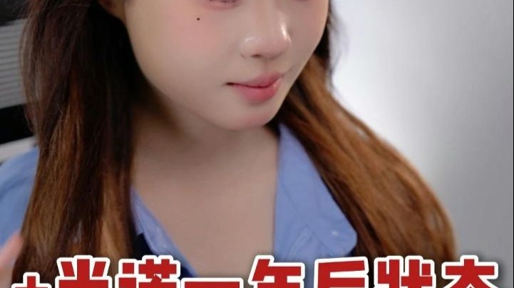 广州植发 | 毛流感+米诺一年后