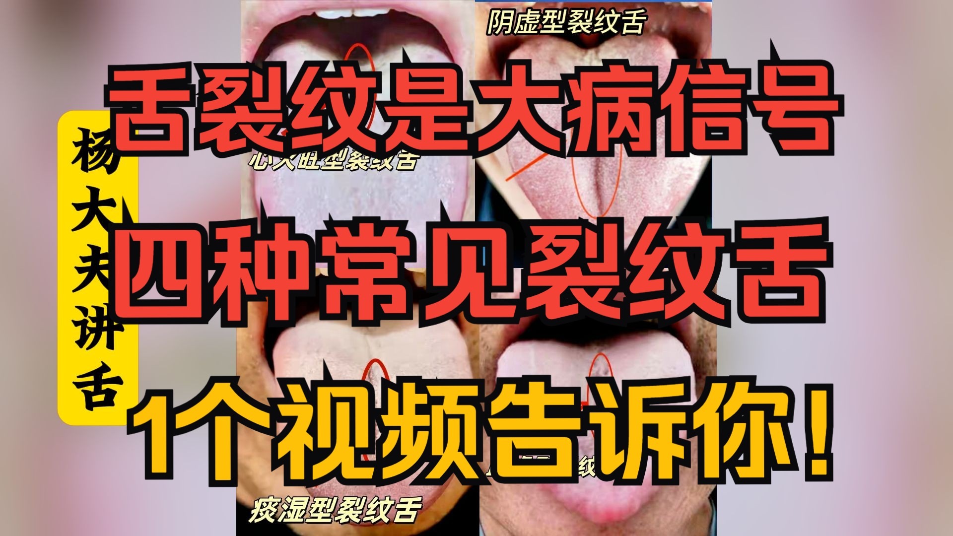 舌面裂纹是 “大病信号”，4 类常见裂纹舌，对照你是哪种？