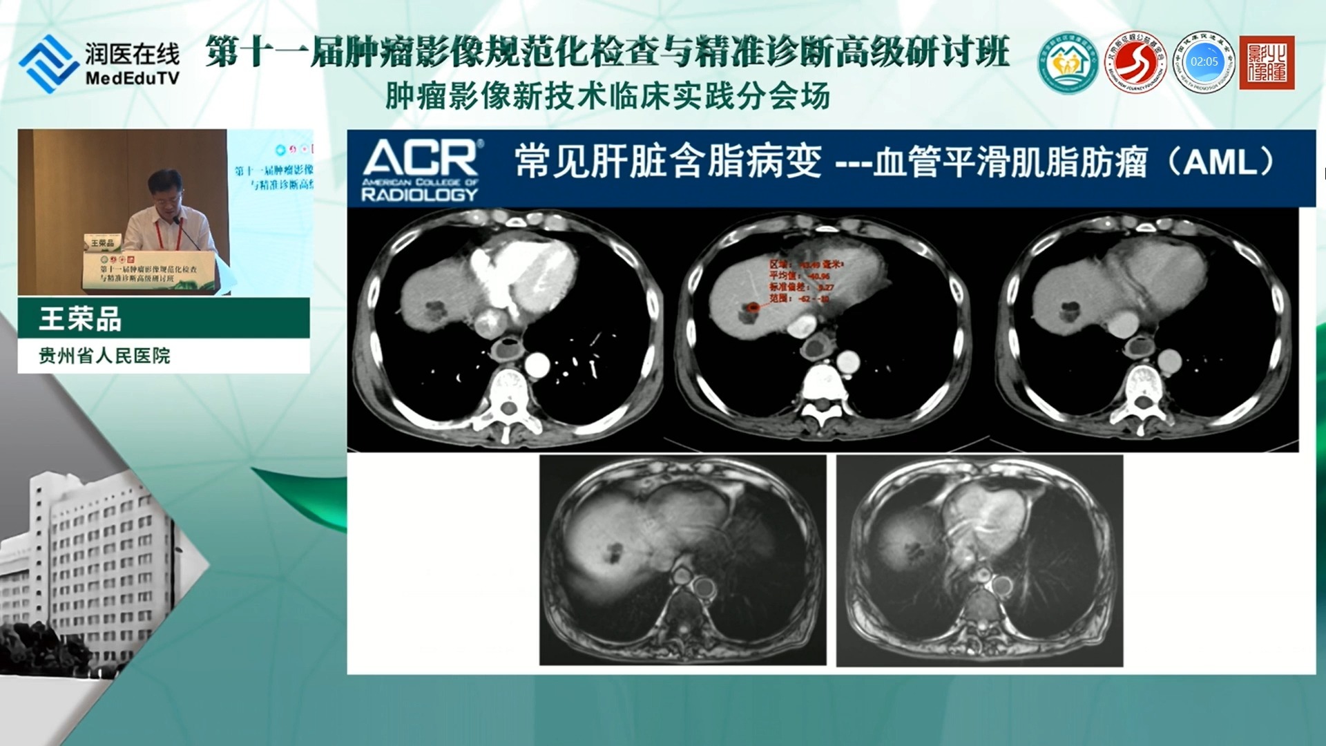 基于LI-RADS的肝脏含脂肪成分病例分析-王荣品