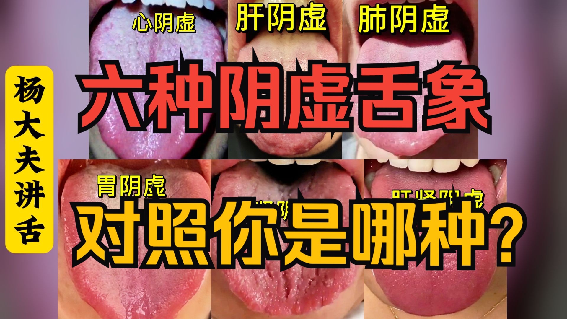六种阴虚舌象，1个视频告诉你，看看你是哪一种？