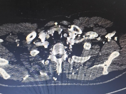 A 型主动脉夹层一例【已破裂】