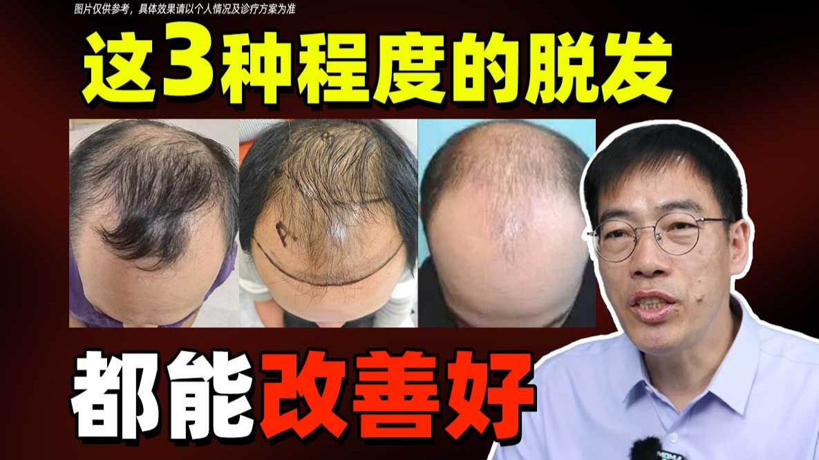 有我在，脱发改善并不难